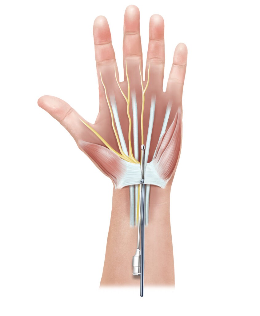 Retinaculumspaltung Karpaltunnelsyndrom – minimal-invasive Behandlung in OÖ