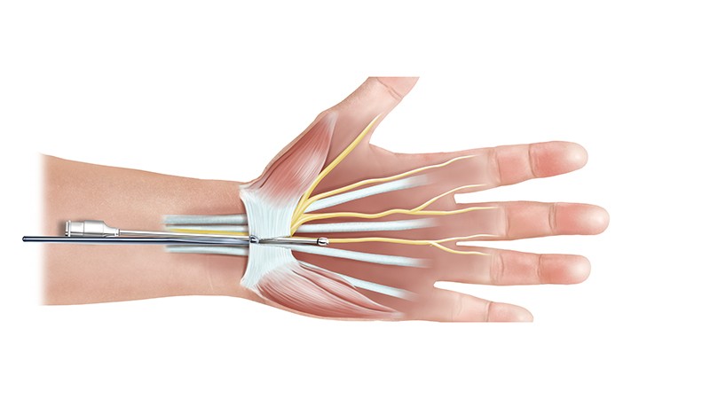 Minimal-invasive ultraschallkontrollierte Retinaculumspaltung:
